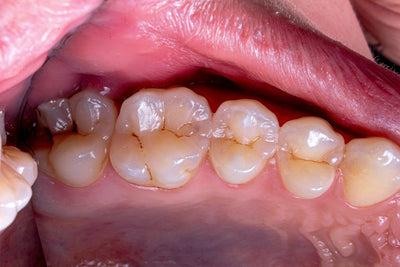 how to stop bleeding gums