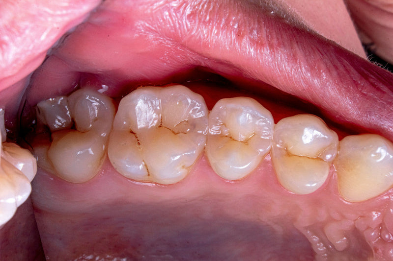 How to Stop Bleeding Gums
