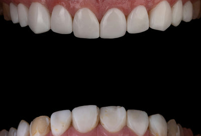 alcohol vs non alcohol mouthwash