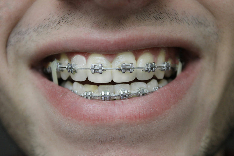 Best Mouthwash For Braces