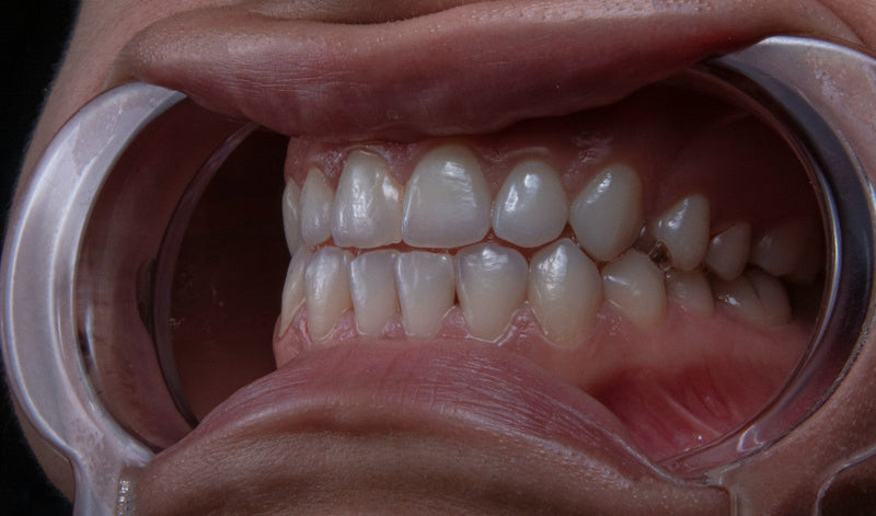 Best Mouthwash For Gingivitis (Top 5 Picks)