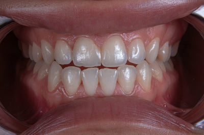 best mouthwash for plaque