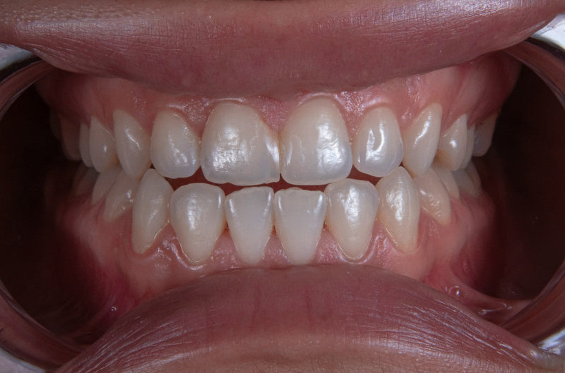 Best Mouthwash for Plaque