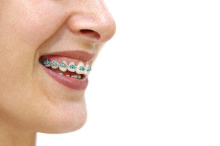 Follow These Tips To Keep Your Braces Clean