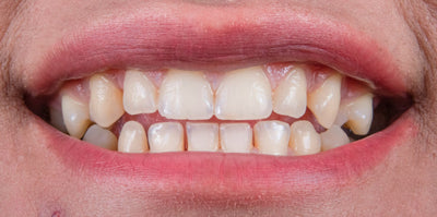 foaming vs non-foaming toothpaste
