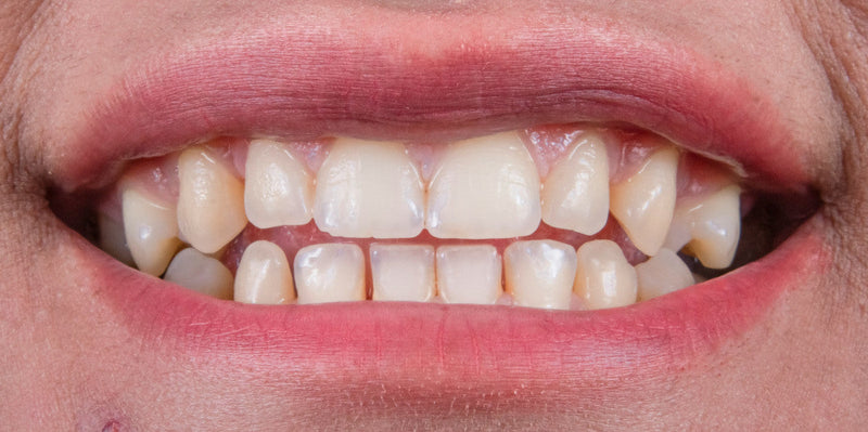 Foaming vs Non-Foaming Toothpaste: Which LIVFRESH Formula is Better?