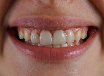 niacinamide vs fluoride toothpaste