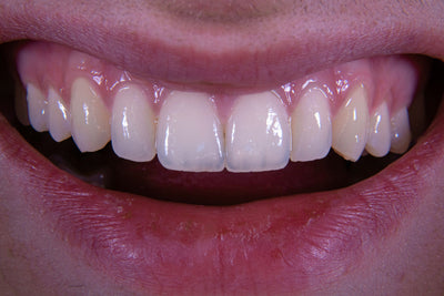 oil pulling vs mouthwash