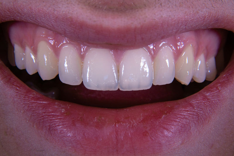 Oil Pulling vs Mouthwash: Is Oil Pulling Better Than Mouthwash?