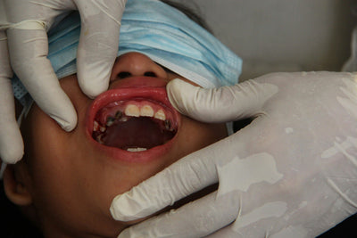 plaque on kids teeth