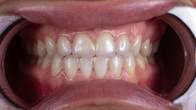 Tooth Powder vs Toothpaste: Which is Better?