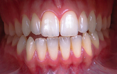 what causes cavities